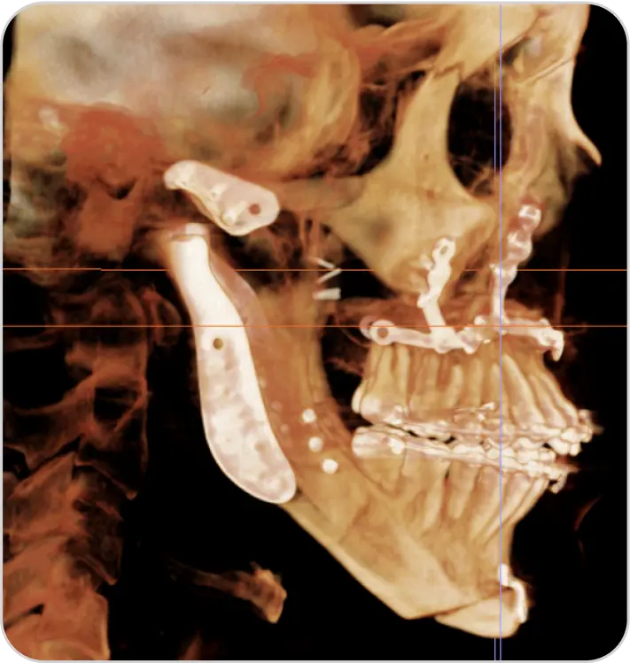 Double Jaw Surgery Relapse 1 Movahed OMS