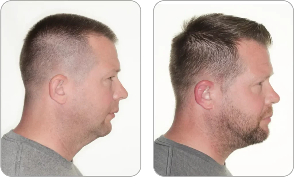 Maxillary Hypoplasia 11 | Movahed OMS
